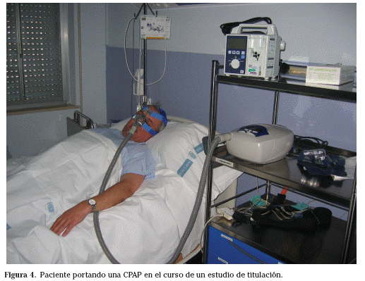 Síndrome de apnea-hipopnea durante el sueño - Wikipedia, la enciclopedia  libre