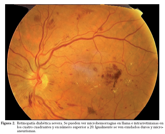 retinopatia diabetica no proliferativa severa)
