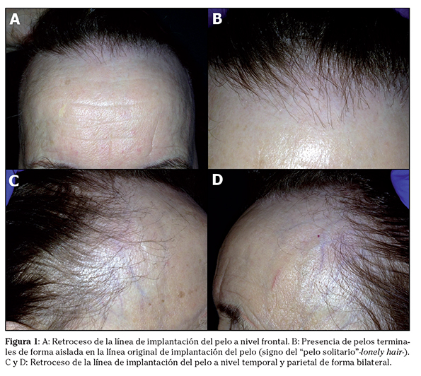 pintar Bocadillo Desviar Alopecia frontal fibrosante: una enfermedad en auge
