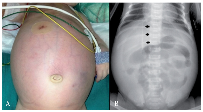 Abdomen De Un Recien Nacido - farewelldiy