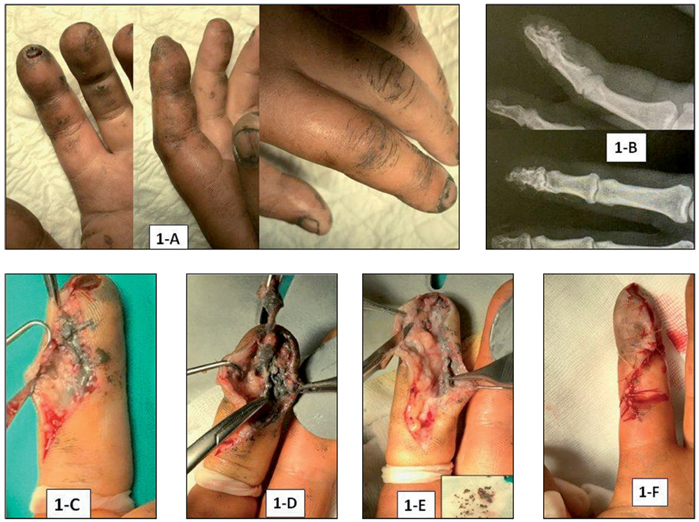 Puntura no sangrante, eritema y edema leve localizado en tercer dedo de