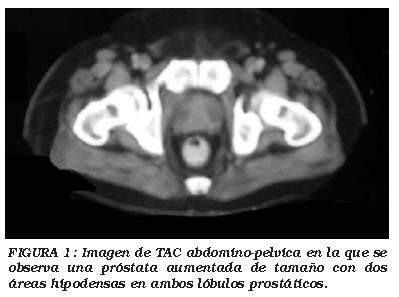 tomografia prostatitei)