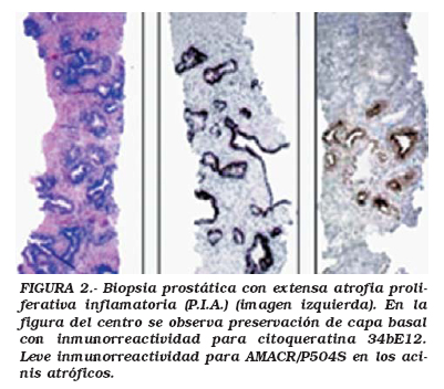 tipos histológicos de cáncer de próstata pdf