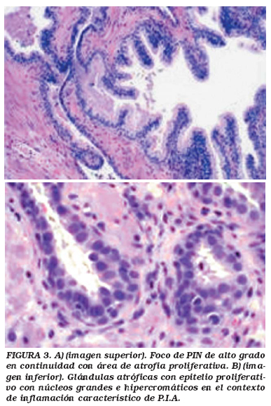 anatomia patologica cancer de prostata pdf