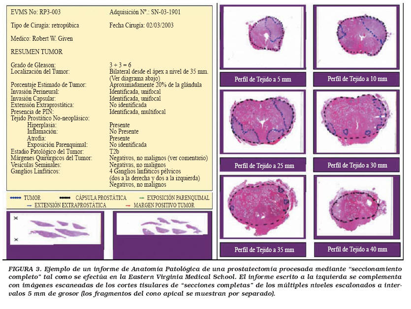 tipos histologicos de cancer de prostata pdf)
