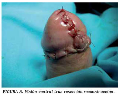 hpv causes depression papilloma on soles of feet