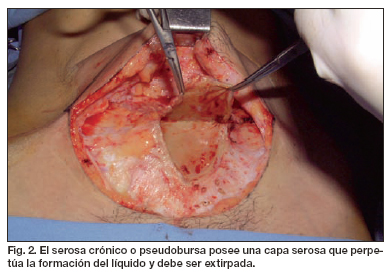 Reparación de hiperfibrosis abdominal secundaria a liposucción