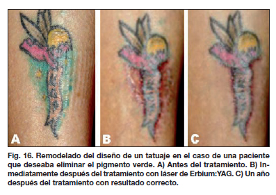 Tatuajes y su eliminación por láser