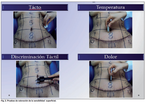 Complicaciones y dolor después de una abdominoplastia - Spanish Hourglass  Tummy Tuck