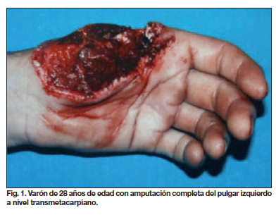 mimar Arreglo incidente Reimplante de pulgar: casuística del Hospital Universitario Virgen del  Rocío (Sevilla) entre los años 2005-2010