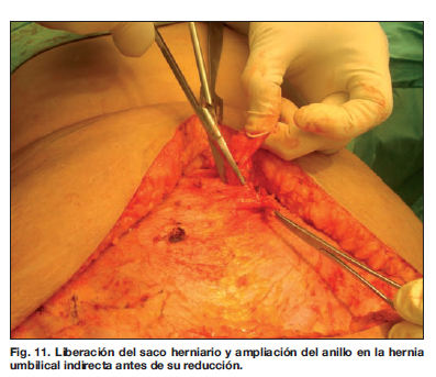 Cirugía abdominal  Dr. Alejandro Tuero. Cirugía Plástica y Estética.