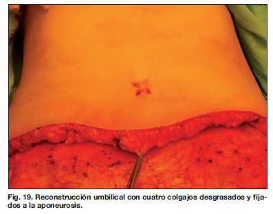 Cirugía abdominal  Dr. Alejandro Tuero. Cirugía Plástica y Estética.