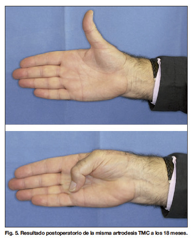 Aries Equipos de Rehabilitación - Ferula para rizartrosis del dedo pulgar  rizartrosis o artrosis de la articulación trapeciometacarpiana del dedo  pulgar, es una de las patologías degenerativas más frecuentes que afectan a