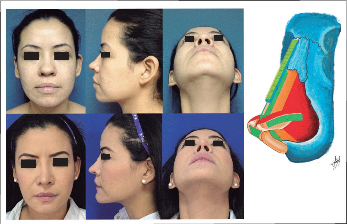 Nariz Rota Antes Y Despues Postoperatorio De La Cirugía De La Nariz