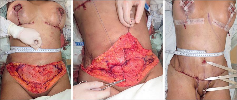 Manual de Cirugía plástica detallada - 1 Abdominoplastia Concepto
