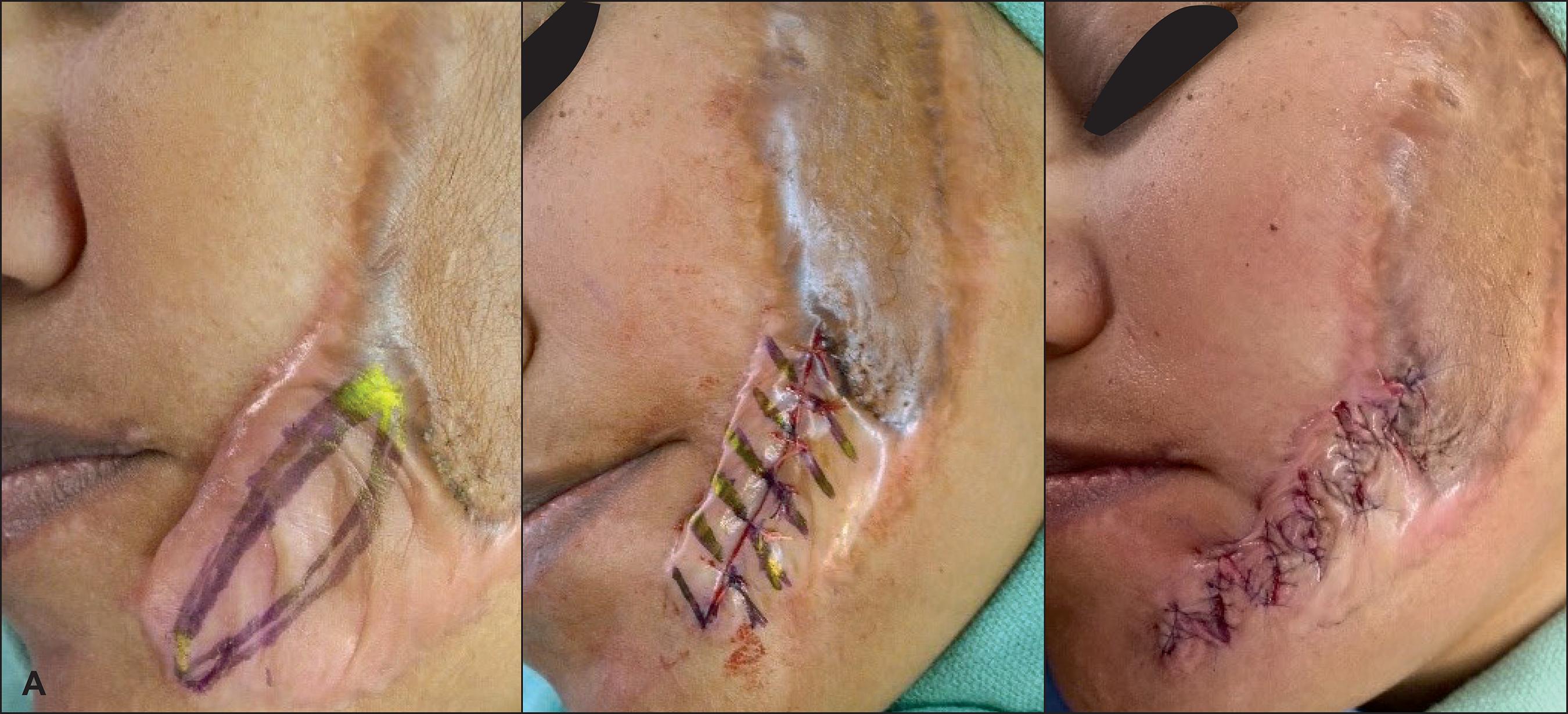 Abrazadera Escarpado interior Cicatriz hipertrófica y queloide: rompiendo paradigmas con el uso de  Z-plastias
