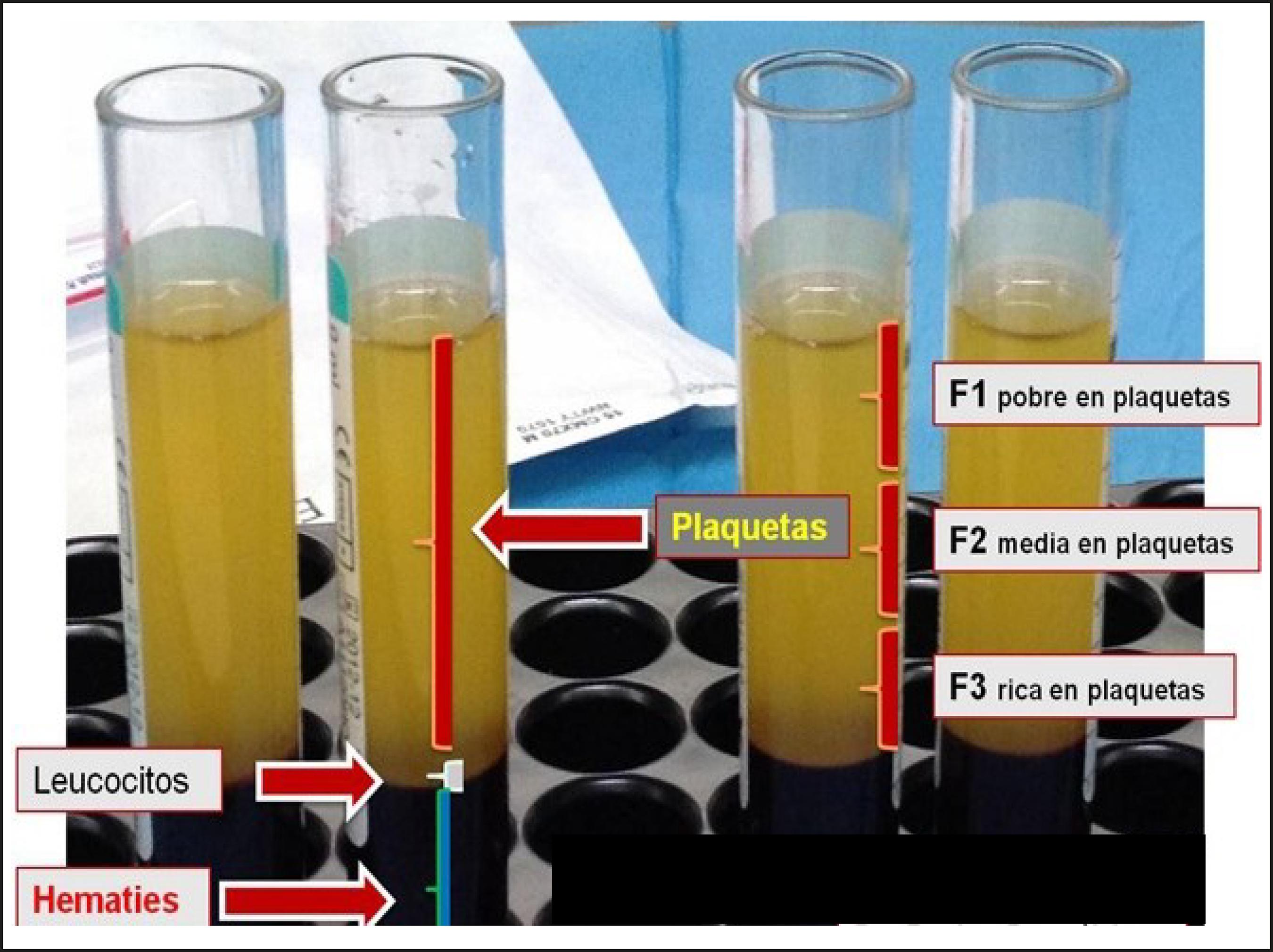 tratamiento-seriado-con-plasma-rico-en-plaquetas-en-rejuvenecimiento
