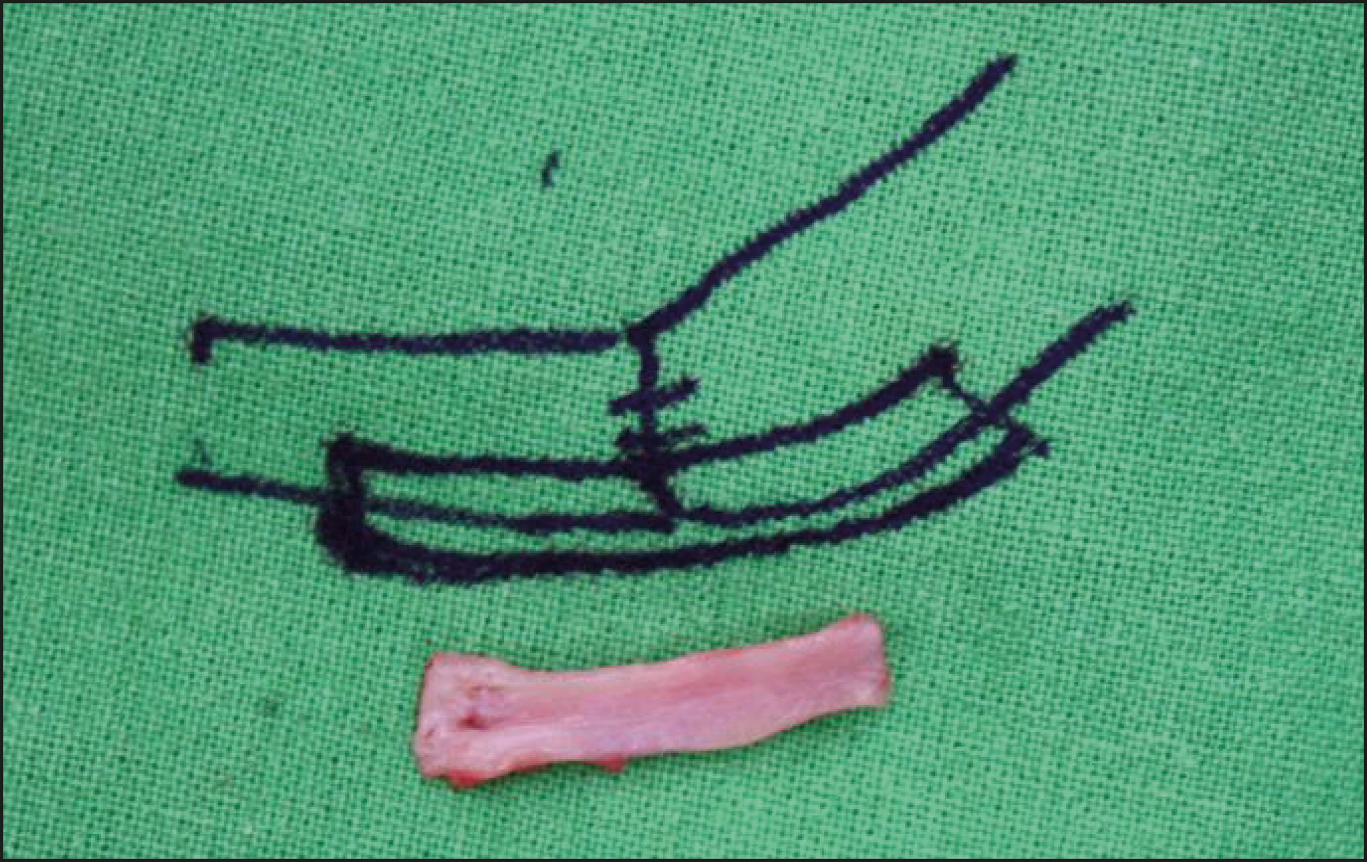 Ferulización de la microanastomosis arterial tras elongar el pedículo