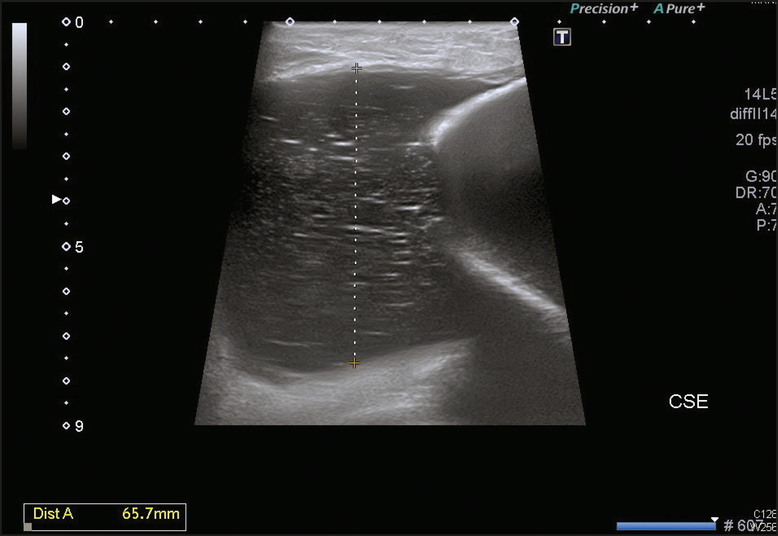 Infección de prótesis mamaria por Haemophilus influenzae