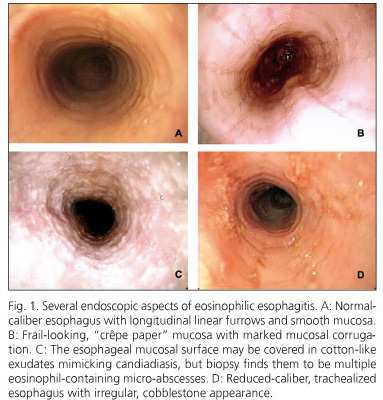 Eosinophilic Esophagitis in children - ppt download