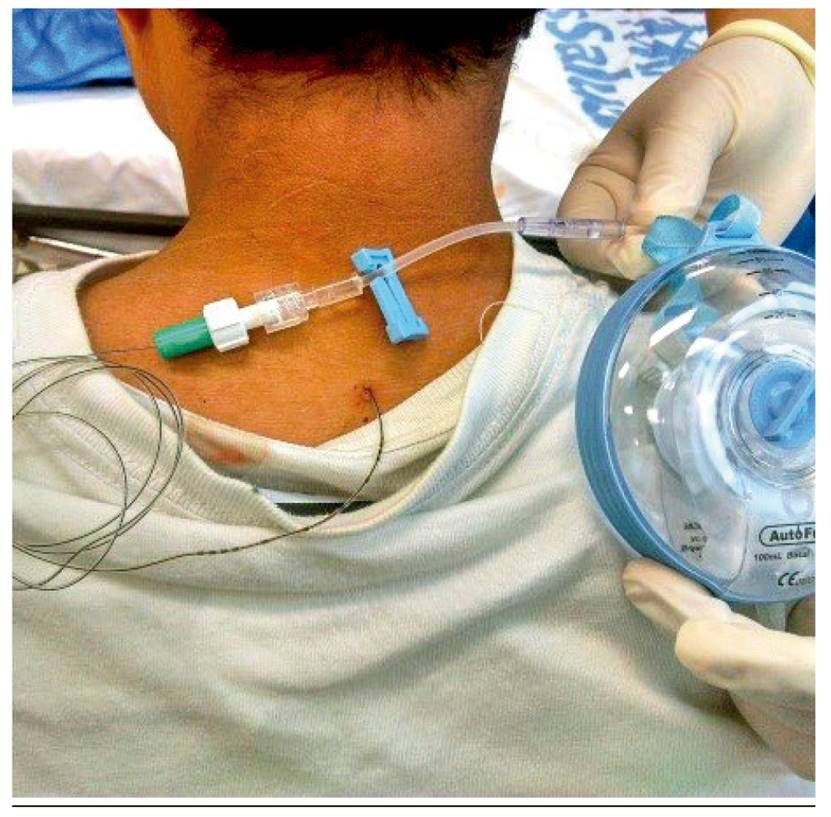 Anestesia y analgesia epidural cervical para cirugía de miembro superior