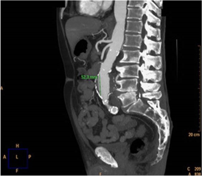 Radiografia De Aneurisma De Aorta Abdominal Aneurisma Micótico De La