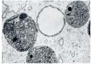 Hepatoesplenomegalia masiva en un paciente con enfermedad de Niemann