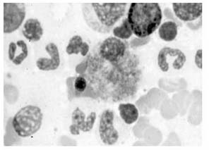 Células espumosas en aspirado de médula ósea en un paciente con