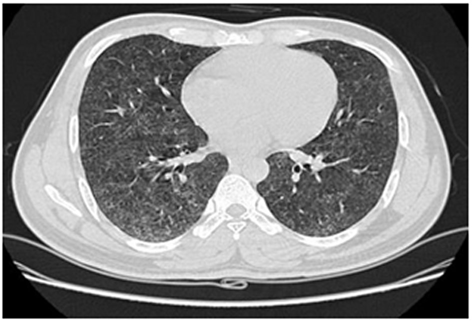 bagassosis-rare-cause-of-hypersensitivity-pneumonitis-a-case-report