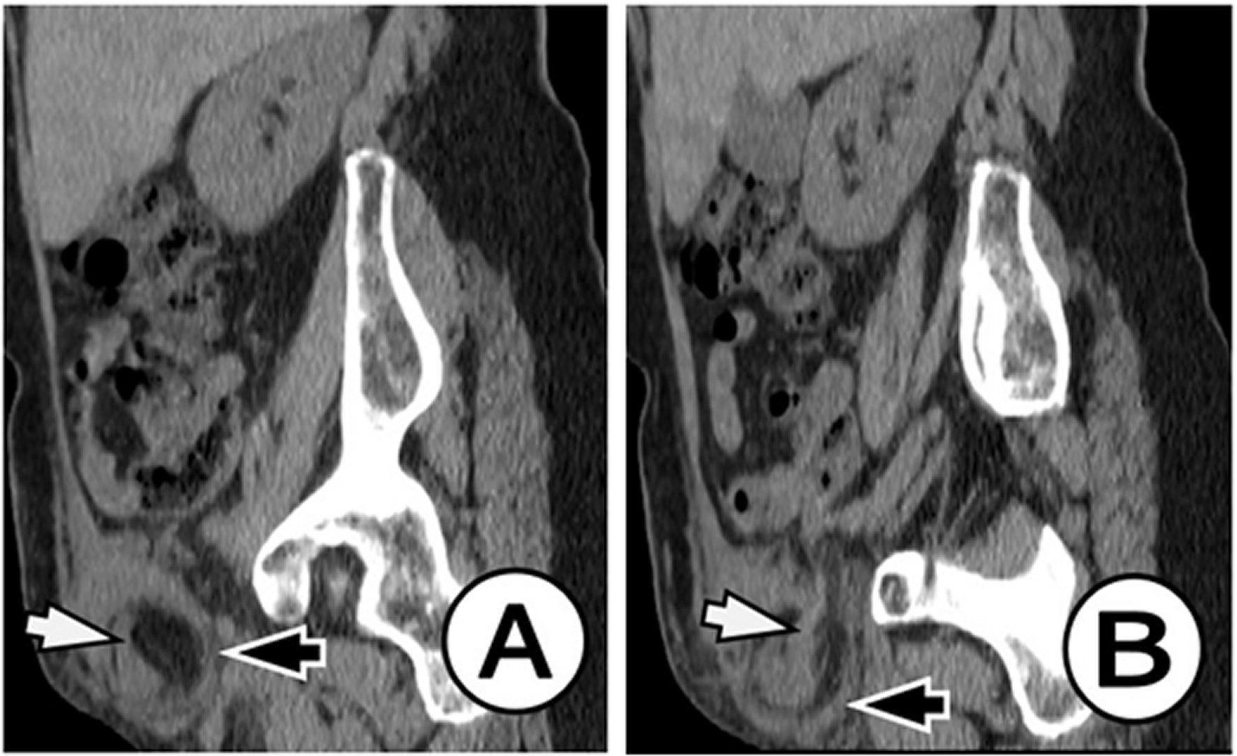 A rare case of Amyand's hernia with acute appendicitis in a 69-year-old ...