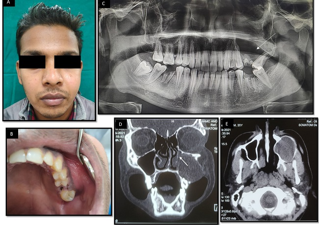 maxillary-sinus-mucocele-in-a-20-year-old-male-a-case-report-of-a-rare