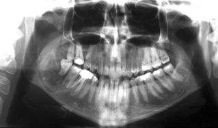 Modelo de maxilar y mandíbula afectada por un pecoma_01 - AJL