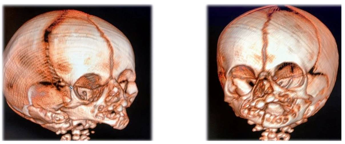 Modelo de maxilar y mandíbula afectada por un pecoma_01 - AJL