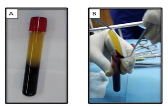 The efficacy of platelet rich fibrin application on secondary implant ...