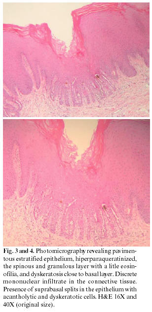 Darier Disease Case Report With Oral Manifestations Darier Disease Case Report With Oral Manifestations