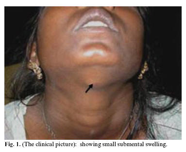 amoxicillin for swollen lymph nodes