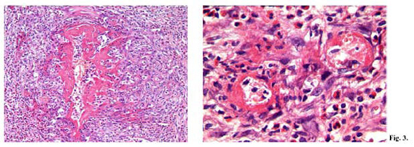 necrotizing microvasculitis in a affected by Kawasaki