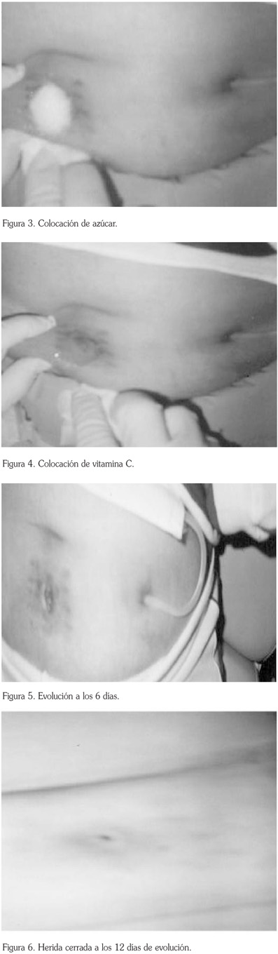 Cura de heridas infectadas post-implantación de catéter peritoneal mediante  tratamiento tópico con azúcar y Vitamina C