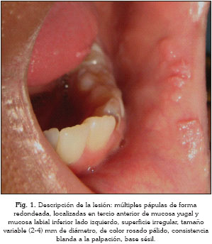 Papilloma virus boca, Papiloma boca imagenes