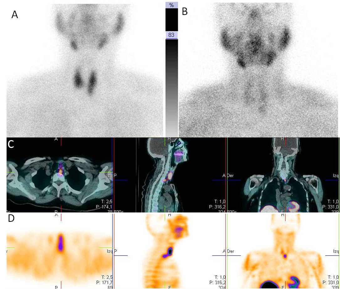 Medicina Nuclear. Diagnóstico De La Patología De Tiroides Y Paratiroides