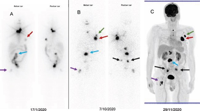 Evolución Del Tratamiento Con Radioyodo En El Carcinoma Diferenciado De ...