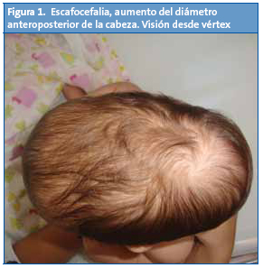 Figura 1. Escafocefalia, aumento del dimetro anteroposterior de la cabeza. Visin desde vrtex
