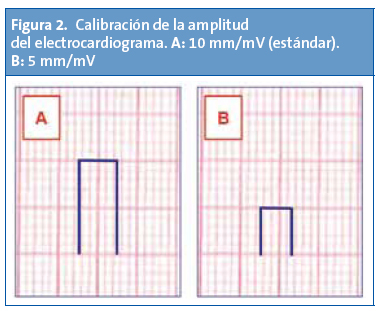 Figura 2. Calibración de la amplitud del electrocardiograma. A:10mm/mV (estádar). B: 5mm/mV