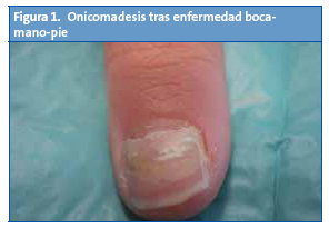 las uñas se caen: la onicomadesis