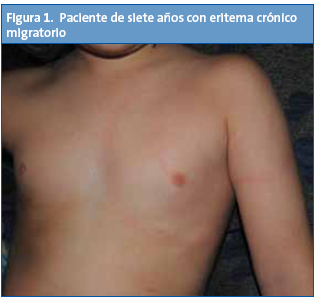 Figura 1. Paciente de siete años con eritema crónico migratorio