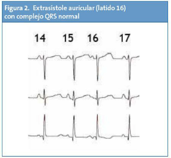 Figura 2. Extrasístole auricular (latido 16) con complejo QRS normal