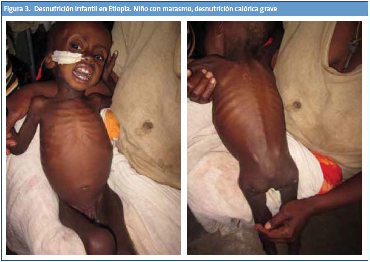 Figura 3. Desnutrición infantil en Etiopía. Niño con marasmo, desnutrición calórica grave