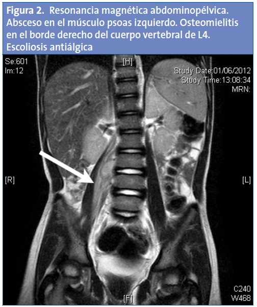Figura 2. Resonancia magnética abdominopélvica. Absceso en el músculo psoas izquierdo. Osteomielitis en el borde derecho del cuerpo vertebral de L4. Escoliosis antiálgica