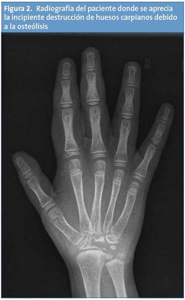 Figura 2. Radiografía del paciente donde se aprecia la incipiente destrucción de huesos carpianos debido a la osteólisis