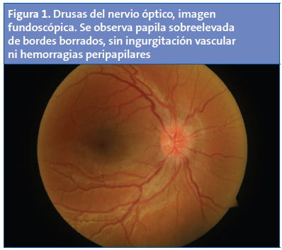 Figura 1. Drusas del nervio óptico, imagen fundoscópica. Se observa papila sobreelevada de bordes borrados, sin ingurgitación vascular ni hemorragias peripapilares.